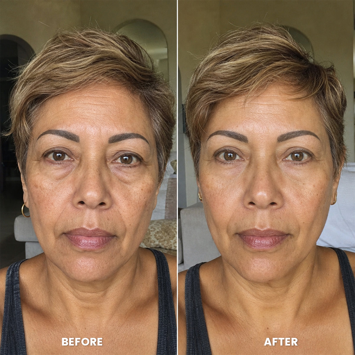 Before and after hooded lids